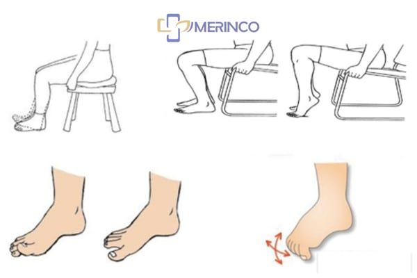 Suy giãn tĩnh mạch mạn tính có được tập thể dục không?
