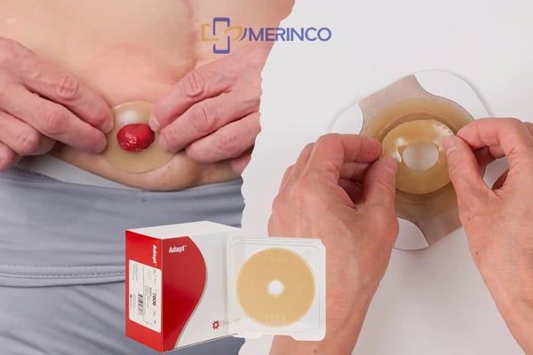 Vòng chống loét sử dụng như thế nào?