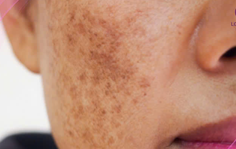 Những Nguy Cơ Tiềm Ẩn Của Kem Trộn Trắng Da: Làn Da Khó Phục Hồi và Hậu Quả Đáng Sợ