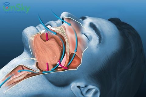 Hội chứng ngưng thở khi ngủ và cách phát hiện