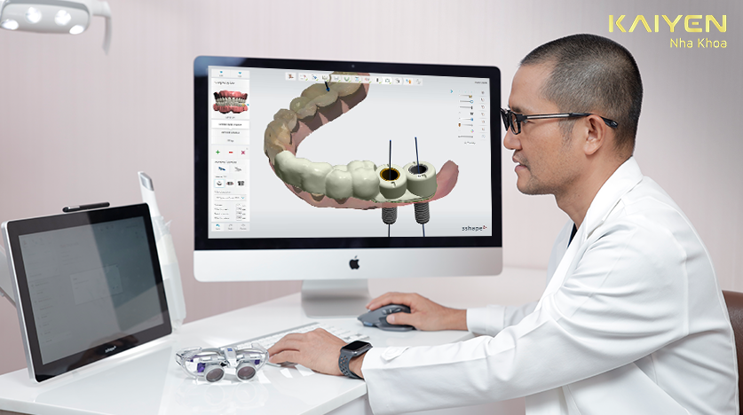 CẤY GHÉP IMPLANT – GIẢI PHÁP TOÀN DIỆN CHO NGƯỜI MẤT RĂNG