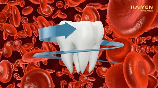 Bệnh máu không đông có trồng răng Implant được không?