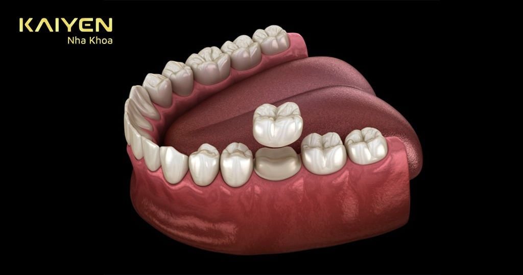 Bọc răng sứ 1 chiếc được không? Giá bao nhiêu tiền?