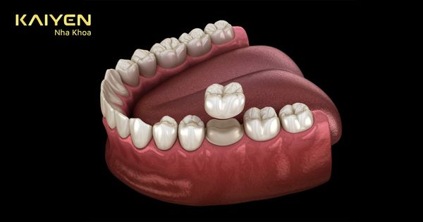 Bọc răng sứ 1 chiếc được không? Giá bao nhiêu tiền?