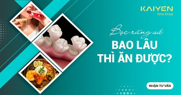 Sau bọc răng sứ bao lâu thì ăn được? Mới bọc sứ cần kiêng gì?