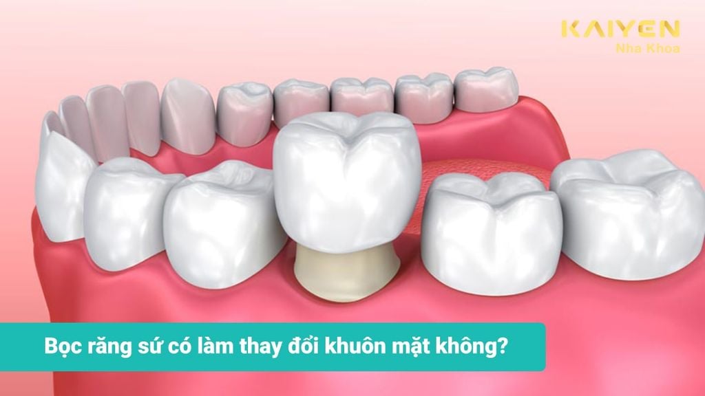 Bọc răng sứ có làm thay đổi khuôn mặt hay không?