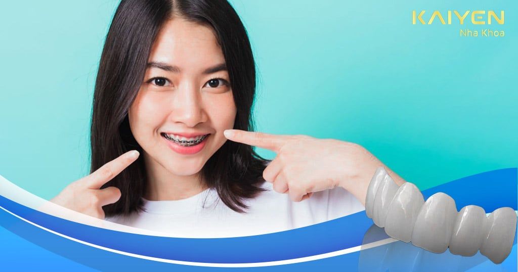 [Góc tư vấn] Bọc răng sứ có niềng răng được không?