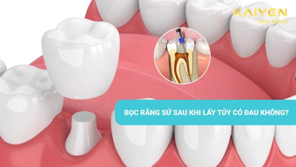 Bọc răng sứ sau khi lấy tủy có đau không?
