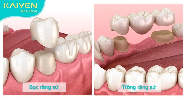 Bọc răng sứ và trồng răng sứ: So sánh sự khác biệt