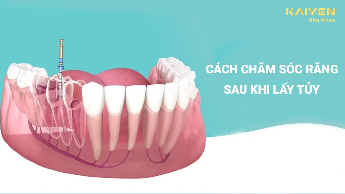 Cách chăm sóc răng sau khi lấy tủy và một số lưu ý