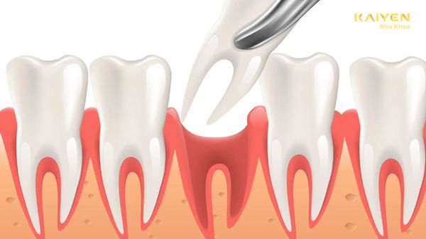 Nuốt phải máu sau khi nhổ răng có sao không?