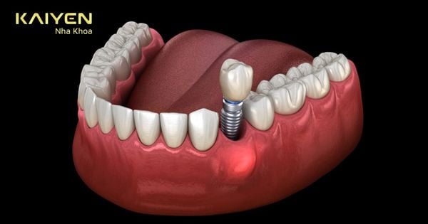 Cắm Implant bị đau nhức: Cảnh giác triệu chứng bất thường