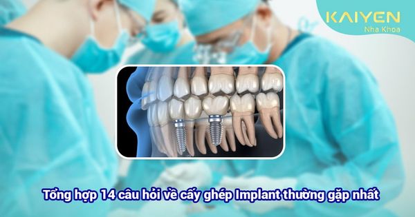 TOP 14 câu hỏi về cấy ghép Implant thường gặp