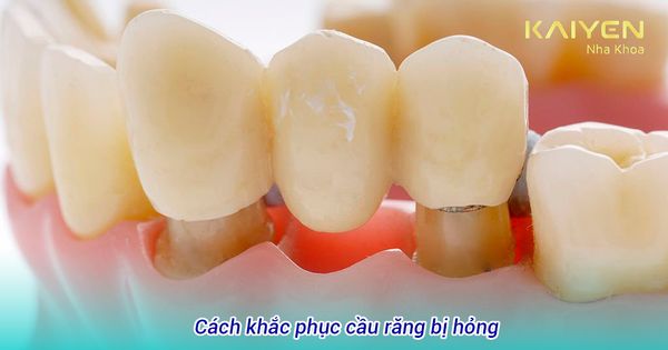 Cầu răng bị hỏng: Nguyên nhân, biểu hiện và cách khắc phục