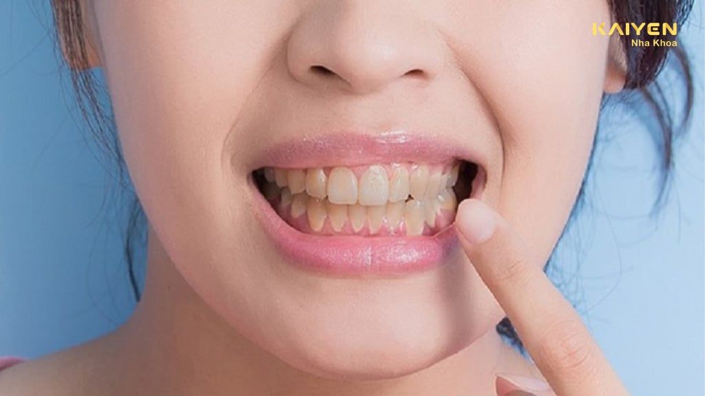Chân răng bị vàng: Nguyên nhân và cách điều trị hiệu quả