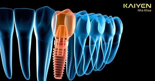 Chân răng nhân tạo Implant: Quy trình thực hiện và giá thành