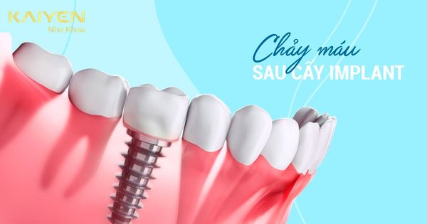 Chảy máu sau khi cắm Implant: Nguyên nhân và cách khắc phục