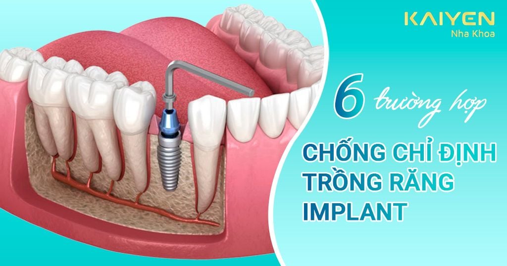 6 Trường hợp chống chỉ định trồng răng Implant bạn cần biết