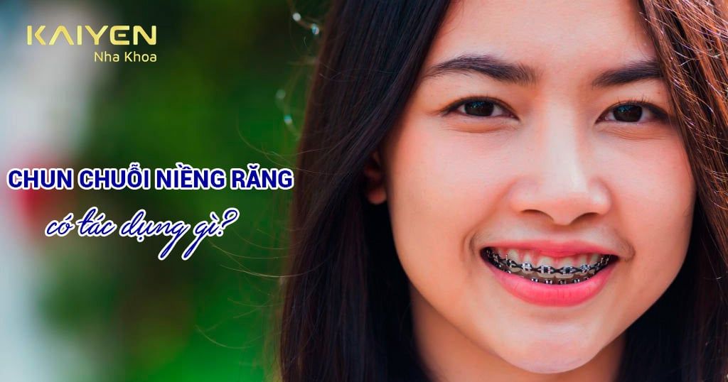 Chun chuỗi niềng răng có tác dụng gì? Trường hợp, thời gian thực hiện