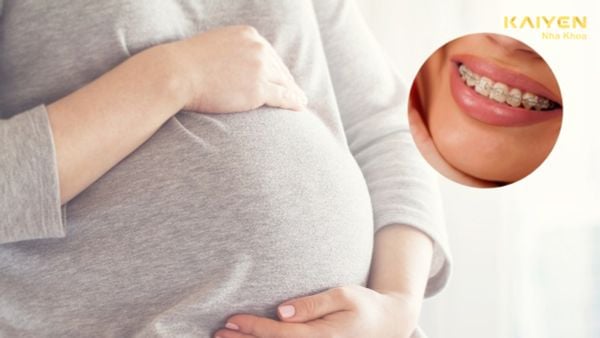 Có bầu niềng răng được không? Có ảnh hưởng đến thai nhi không?