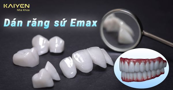 Dán răng sứ Emax có tốt không? Cập nhật giá dán sứ Veneer Emax mới nhất