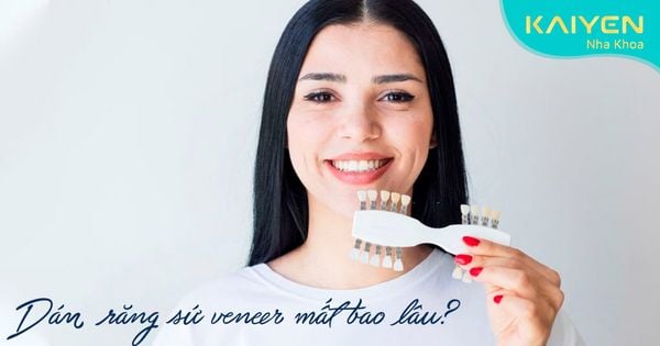 Thời gian dán răng sứ - làm mặt răng sứ veneer mất bao lâu?