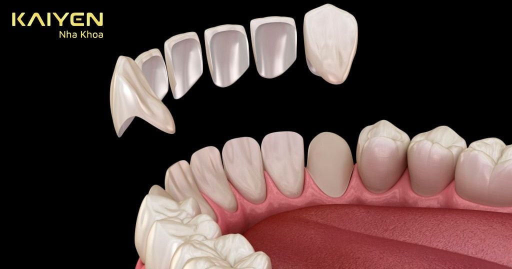 Dán răng sứ và bọc răng sứ: Nên lựa chọn loại nào tốt?