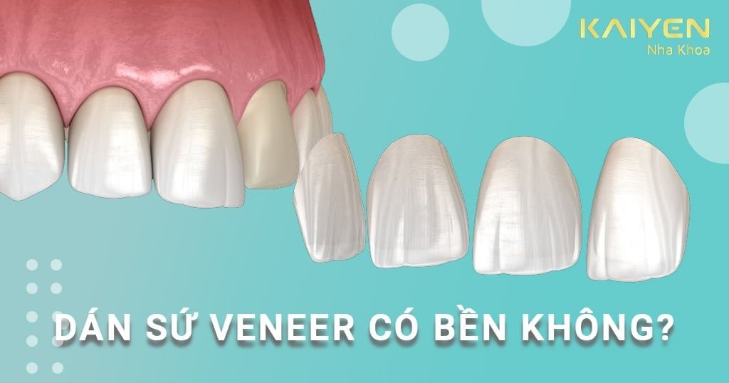 Dán răng sứ Veneer có bền không? Sử dụng được bao lâu?