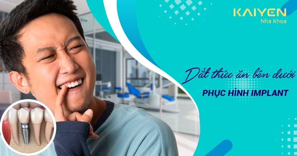 Cách khắc phục khi bị dắt thức ăn bên dưới phục hình Implant