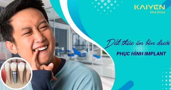 Cách khắc phục khi bị dắt thức ăn bên dưới phục hình Implant