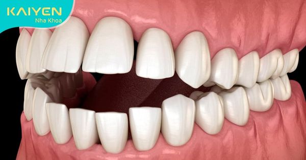 Khớp cắn hở là gì? Tác hại và cách điều trị hiệu quả