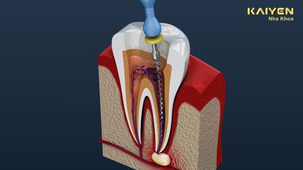 Khi Nào Cần Điều Trị Nội Nha?