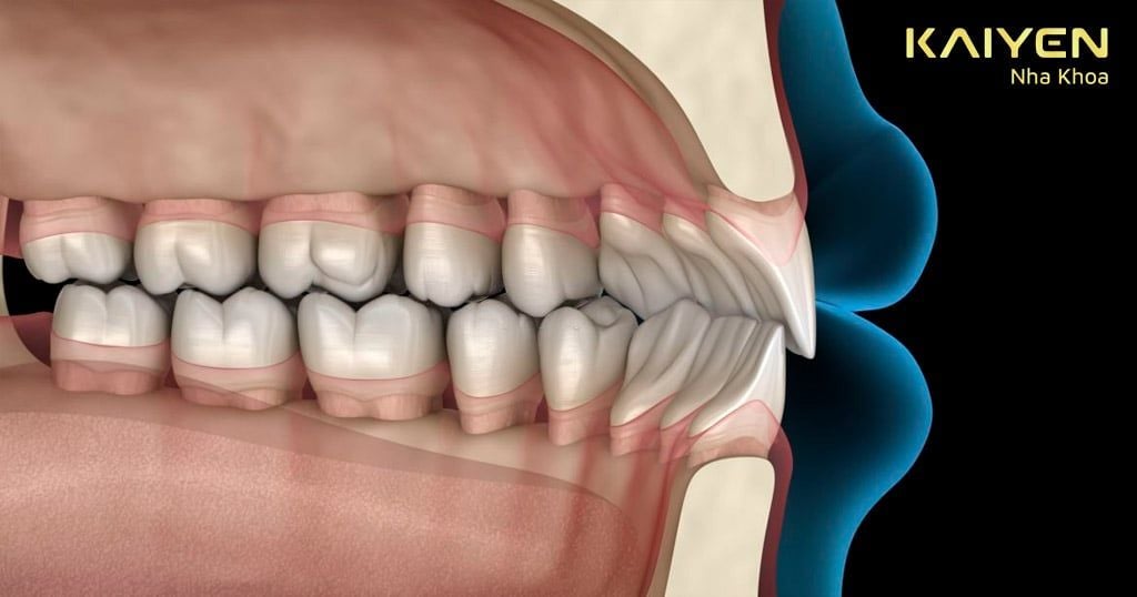 Răng bị hô nhẹ phải làm sao? Phương pháp xử lý hiệu quả