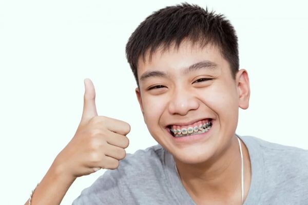 Độ Tuổi Lý Tưởng Nhất Để Có Thể Niềng Răng