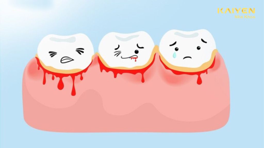 Ê buốt răng kèm chảy máu chân răng có nguy hiểm không?