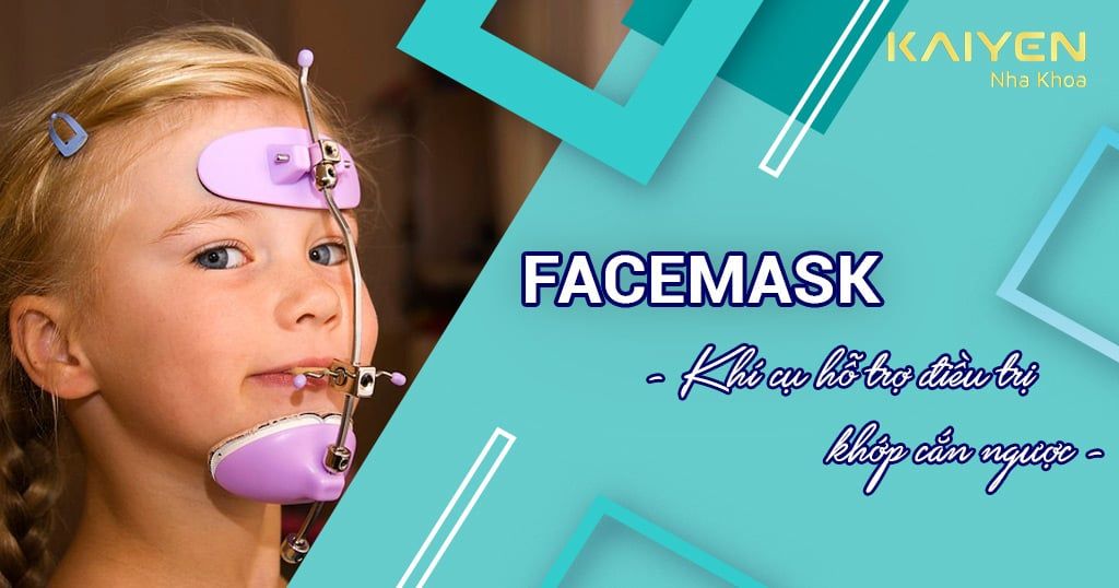 Facemask chỉnh nha – Khí cụ hỗ trợ điều trị khớp cắn ngược cho trẻ