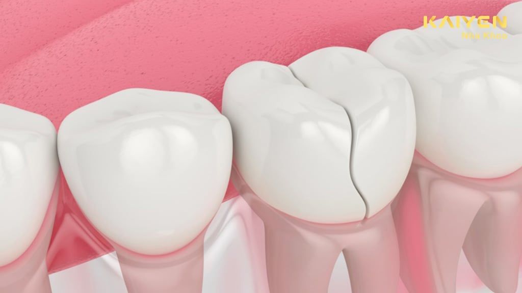 Sự Nguy Hiểm Khi Mất Răng Số 6 Và Phương Pháp Phục Hình Hiện Nay