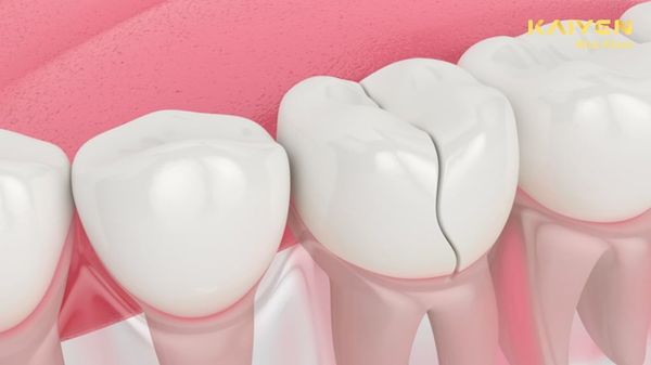 Sự Nguy Hiểm Khi Mất Răng Số 6 Và Phương Pháp Phục Hình Hiện Nay