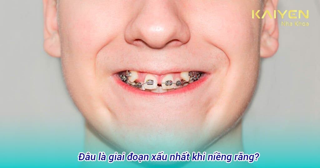 Đâu là giai đoạn xấu nhất khi niềng răng? Cách cải thiện thế nào?