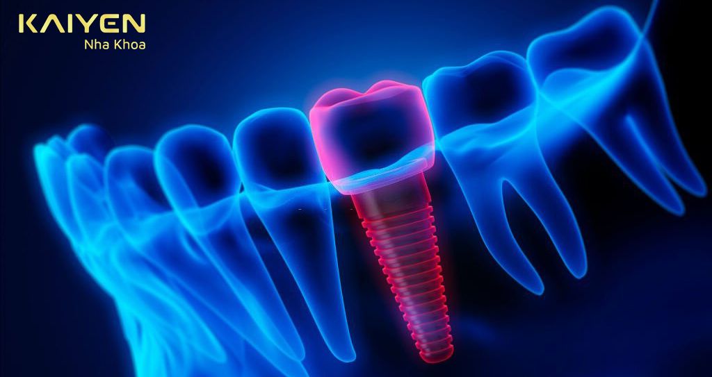 Hướng dẫn cách giảm đau sau cấy ghép Implant