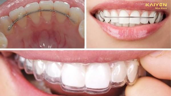 Sau khi niềng răng cần đeo hàm duy trì trong bao lâu?