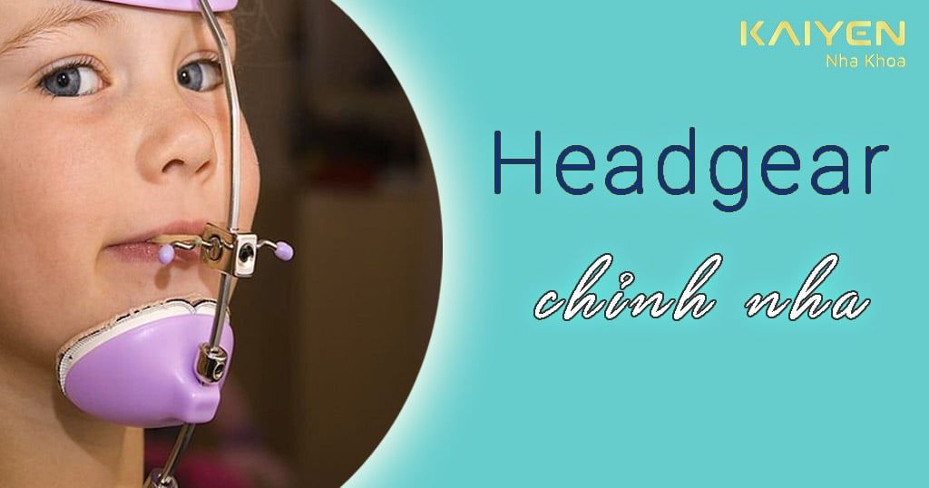 Những điều quan trọng cần biết về Headgear chỉnh nha