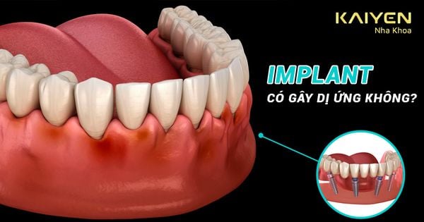 Trồng răng Implant có gây dị ứng không? Các vấn đề thường gặp