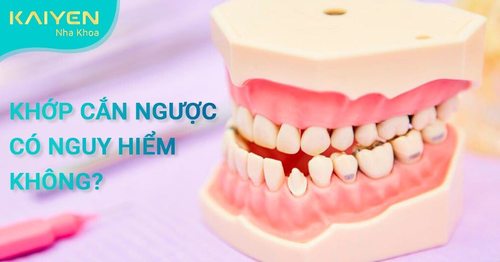 Khớp cắn ngược có nguy hiểm không? Nguyên nhân, cách khắc phục