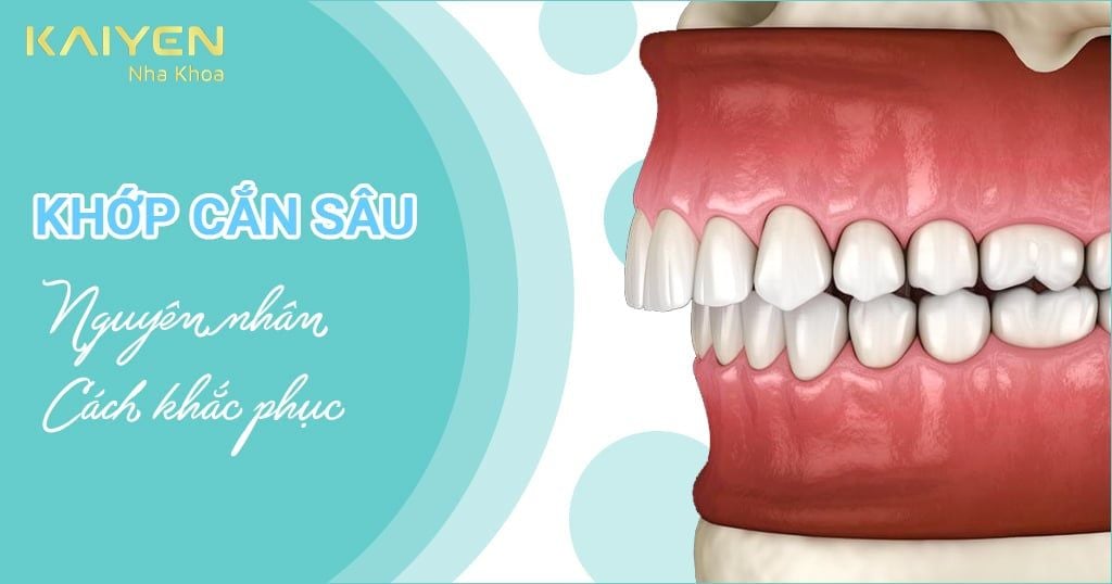 Khớp cắn sâu: Nguyên nhân, tác hại và cách khắc phục