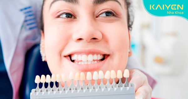 Chia sẻ kinh nghiệm dán răng sứ Veneer từ A đến Z