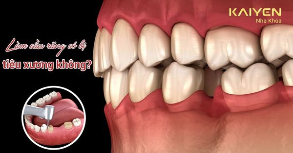 Làm cầu răng sứ có bị tiêu xương không? Giải pháp thay thế tốt nhất?