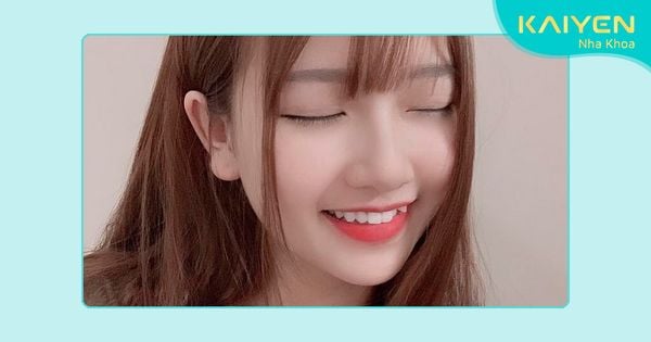 Làm sao để có răng khểnh? Cách làm răng khểnh đẹp tự nhiên, an toàn