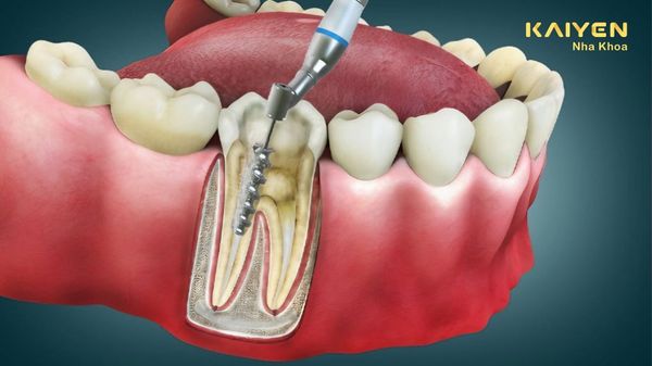 Lấy Tủy Răng Có Đau Không