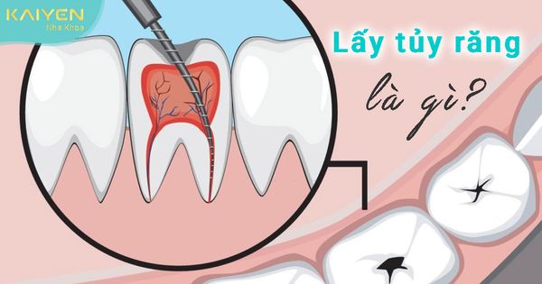 Lấy tủy răng là gì? Những điều cần biết trước khi lấy tủy trám răng